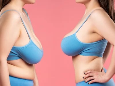 Bauchdeckenstraffung bei erschlafftem Bauch: Ein umfassender Ratgeber für Patienten