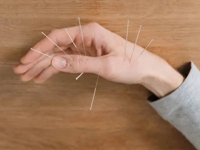 Akupunktura a mindennapi jólétért – Akupunkturbehandlungen usw