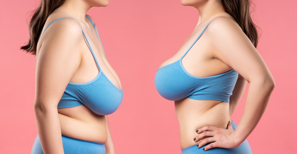 Bauchdeckenstraffung bei erschlafftem Bauch: Ein umfassender Ratgeber für Patienten